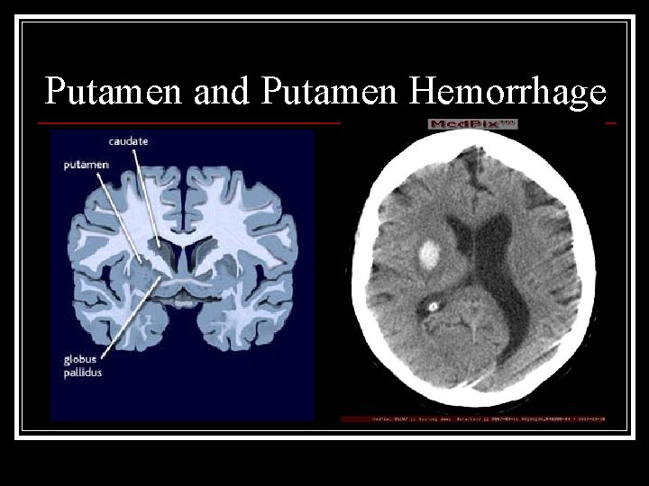 Putamen and Putamen Hemorrhage 