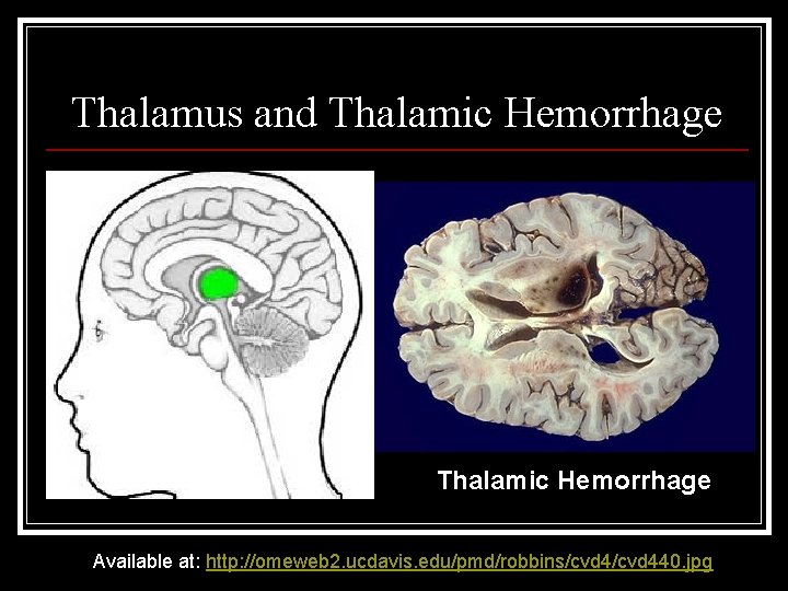 Thalamus and Thalamic Hemorrhage Available at: http: //omeweb 2. ucdavis. edu/pmd/robbins/cvd 440. jpg 