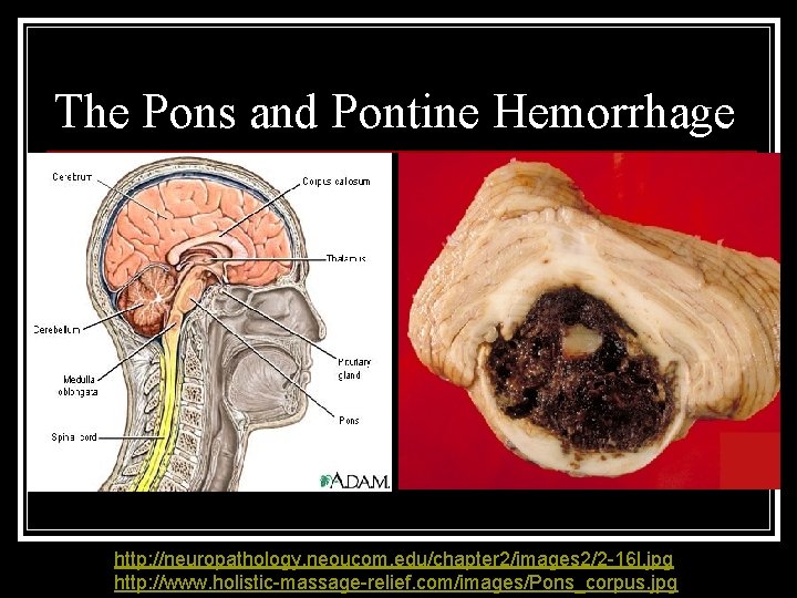 The Pons and Pontine Hemorrhage http: //neuropathology. neoucom. edu/chapter 2/images 2/2 -16 l. jpg