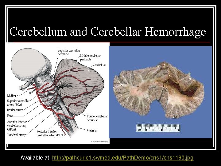 Cerebellum and Cerebellar Hemorrhage Available at: http: //pathcuric 1. swmed. edu/Path. Demo/cns 1190. jpg Cerebellum and Cerebellar Hemorrhage Available at: http: //pathcuric 1. swmed. edu/Path. Demo/cns 1190. jpg