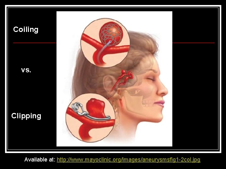 Coiling vs. Clipping Available at: http: //www. mayoclinic. org/images/aneurysmsfig 1 -2 col. jpg 