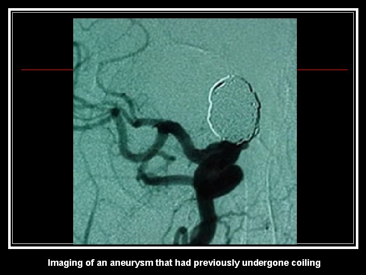 Imaging of an aneurysm that had previously undergone coiling Imaging of an aneurysm that had previously undergone coiling