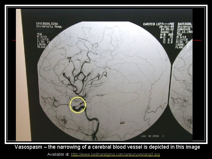 Vasospasm – the narrowing of a cerebral blood vessel is depicted in this image Vasospasm – the narrowing of a cerebral blood vessel is depicted in this image