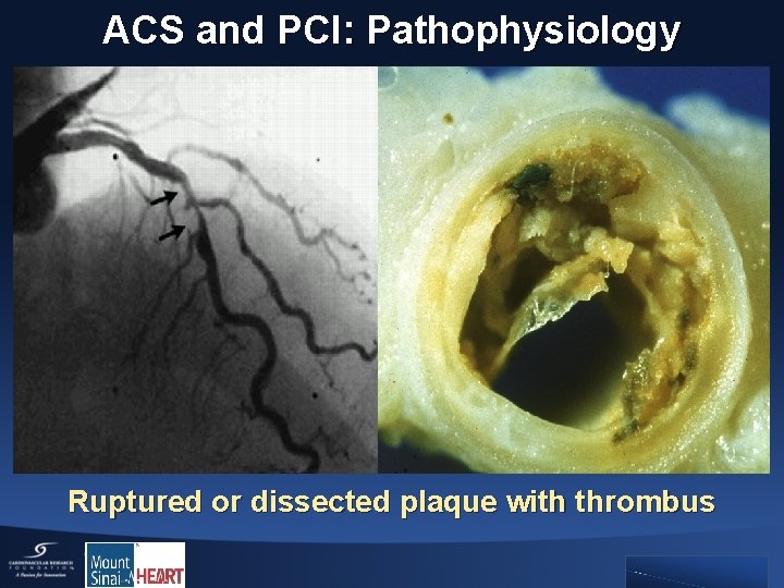ACS and PCI: Pathophysiology Ruptured or dissected plaque with thrombus 