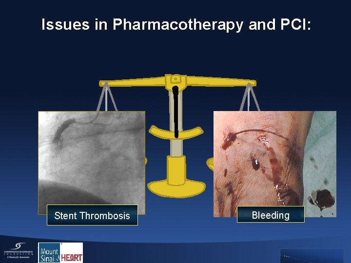 Issues in Pharmacotherapy and PCI: Stent Thrombosis bleeding Bleeding 