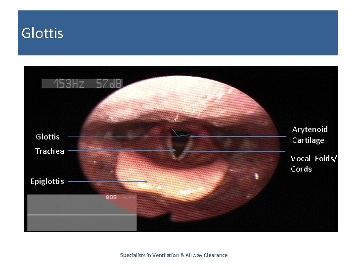 Glottis Arytenoid Cartilage Glottis Trachea Vocal Folds/ Cords Epiglottis Specialists in Ventilation & Airway