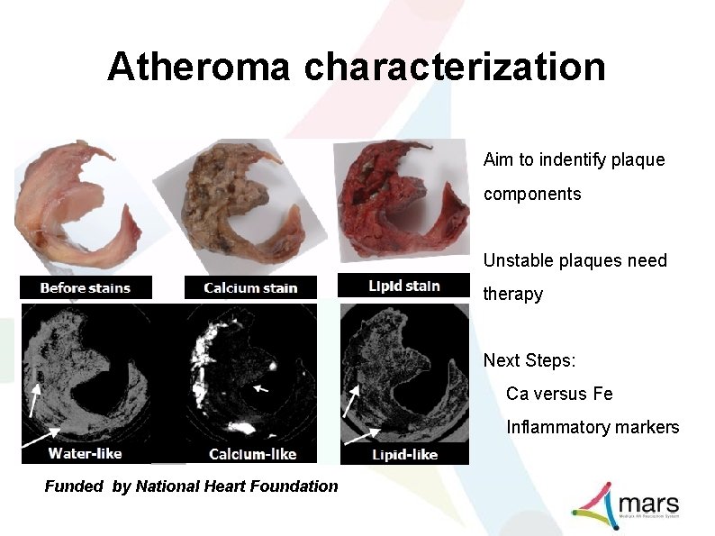 Atheroma characterization Aim to indentify plaque components Unstable plaques need therapy Next Steps: Ca