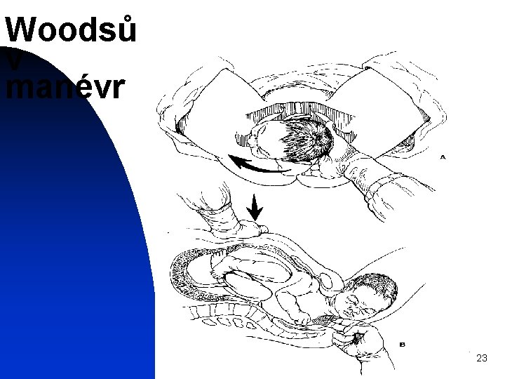 Woodsů v manévr 23 