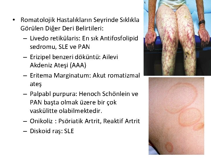  • Romatolojik Hastalıkların Seyrinde Sıklıkla Görülen Diğer Deri Belirtileri: – Livedo retikülaris: En