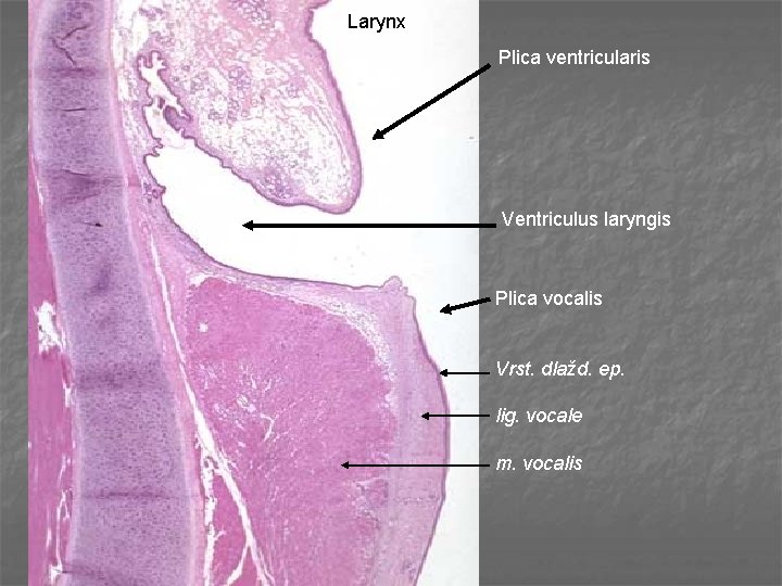 Larynx Plica ventricularis Ventriculus laryngis Plica vocalis Vrst. dlažd. ep. lig. vocale m. vocalis