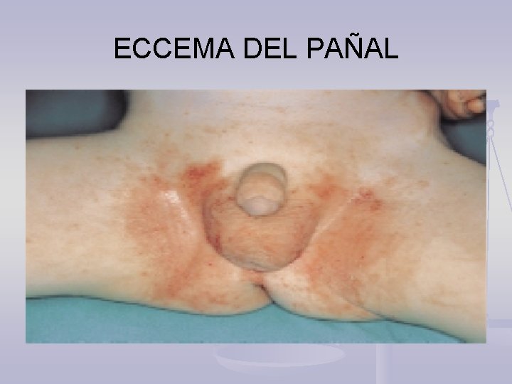ECCEMA DEL PAÑAL 