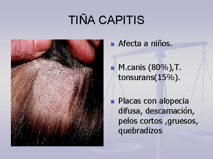 TIÑA CAPITIS n n n Afecta a niños. M. canis (80%), T. tonsurans(15%). Placas