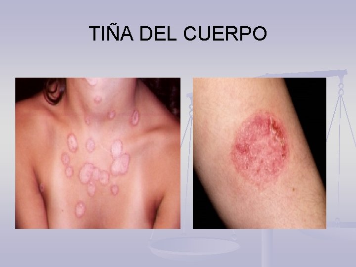 TIÑA DEL CUERPO 