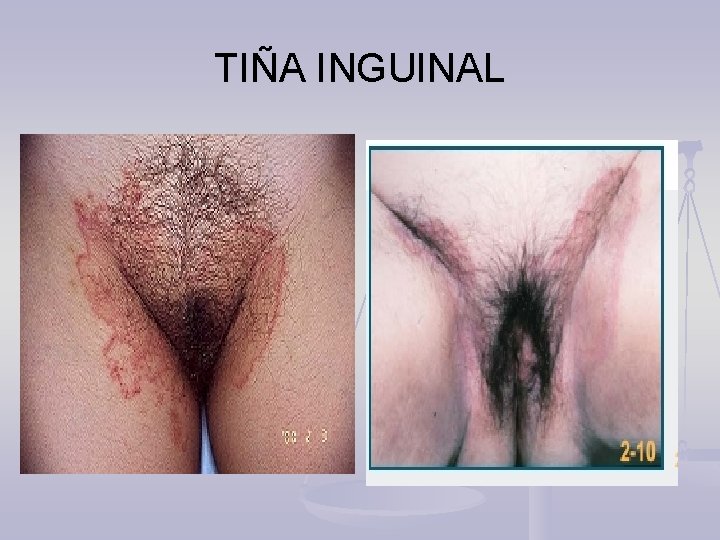TIÑA INGUINAL 