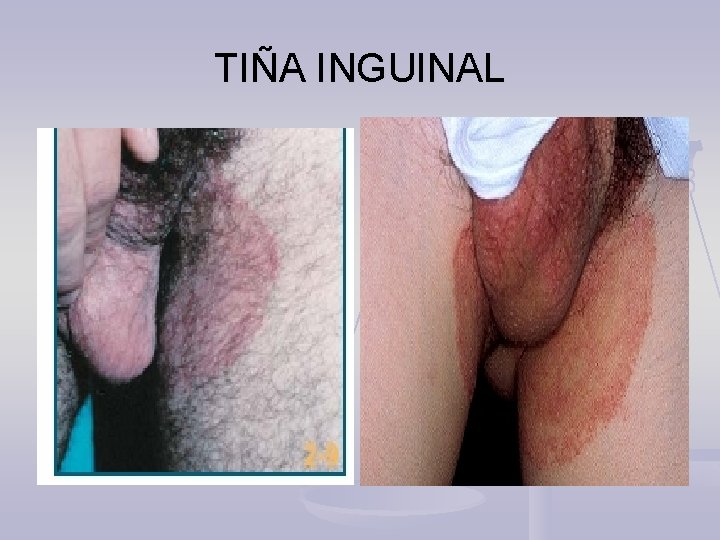 TIÑA INGUINAL 