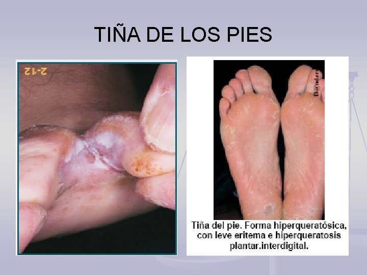 TIÑA DE LOS PIES 