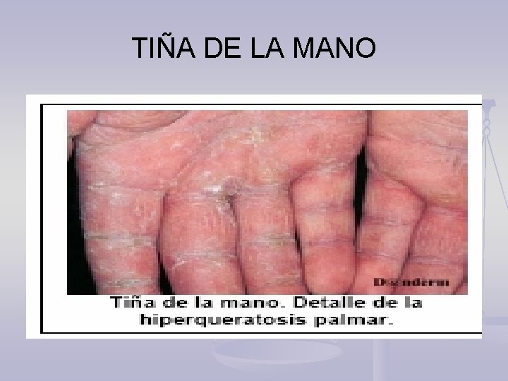 TIÑA DE LA MANO 