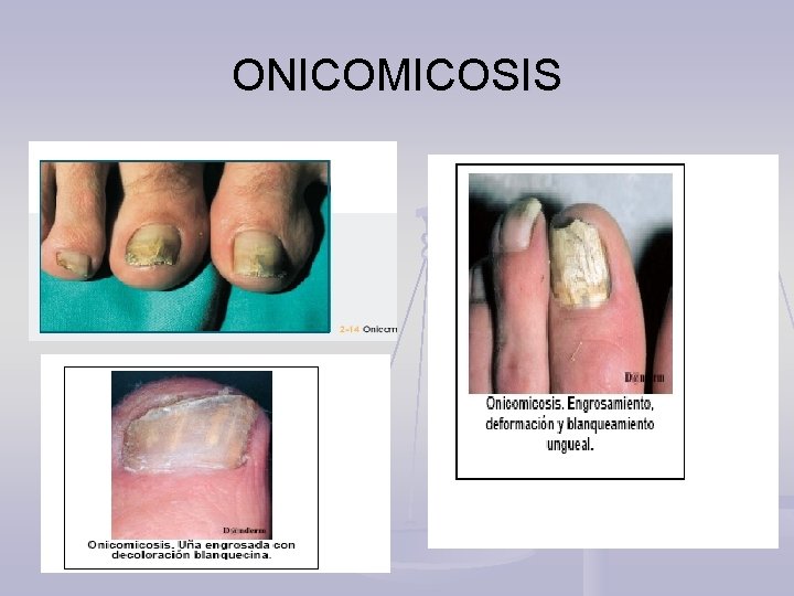ONICOMICOSIS 