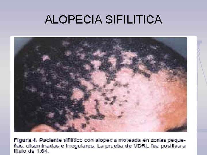 ALOPECIA SIFILITICA 