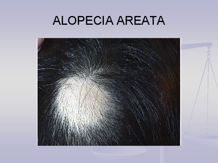 ALOPECIA AREATA 