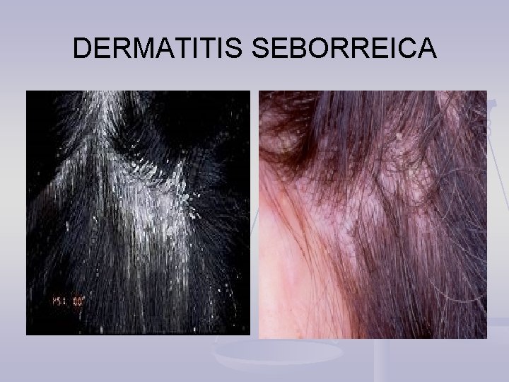 DERMATITIS SEBORREICA 