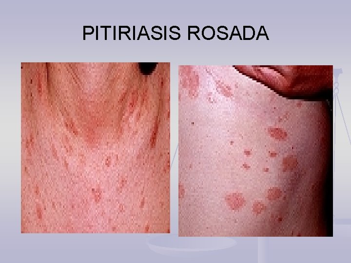 PITIRIASIS ROSADA 
