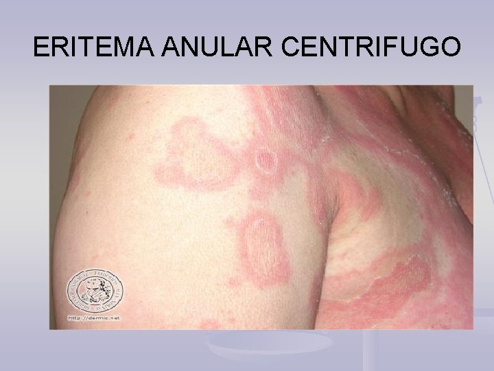 ERITEMA ANULAR CENTRIFUGO 