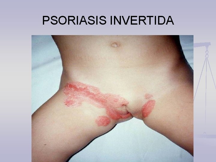 PSORIASIS INVERTIDA 