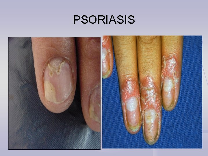 PSORIASIS 