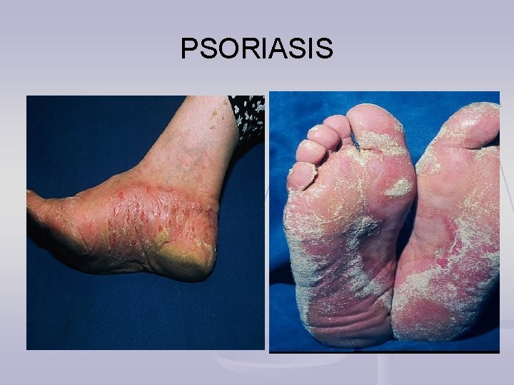PSORIASIS 