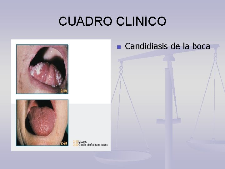 CUADRO CLINICO n Candidiasis de la boca 