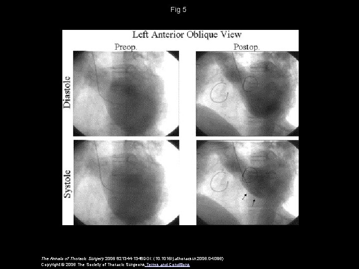 Fig 5 The Annals of Thoracic Surgery 2006 821344 -1348 DOI: (10. 1016/j. athoracsur.
