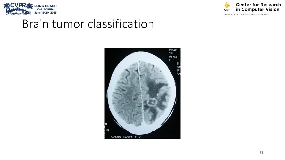 Brain tumor classification 73 