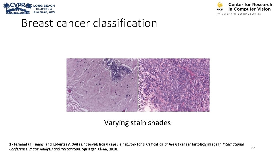 Breast cancer classification Varying stain shades 17 Iesmantas, Tomas, and Robertas Alzbutas. "Convolutional capsule