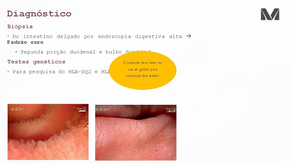 Diagnóstico Biópsia • Do intestino delgado por endoscopia digestiva alta Padrão ouro • Segunda