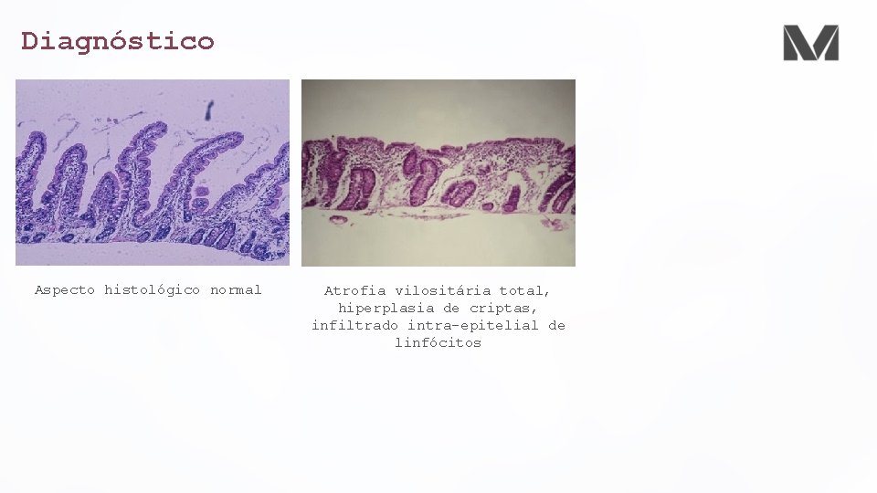 Diagnóstico Aspecto histológico normal Atrofia vilositária total, hiperplasia de criptas, infiltrado intra-epitelial de linfócitos