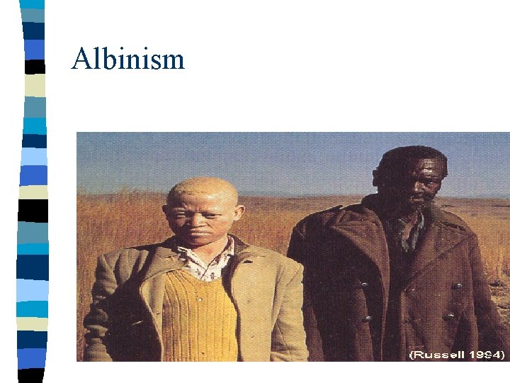 Albinism 15 