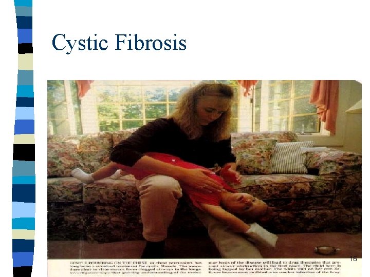 Cystic Fibrosis 16 