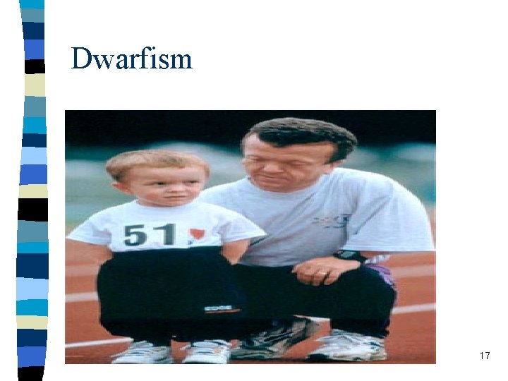 Dwarfism 17 