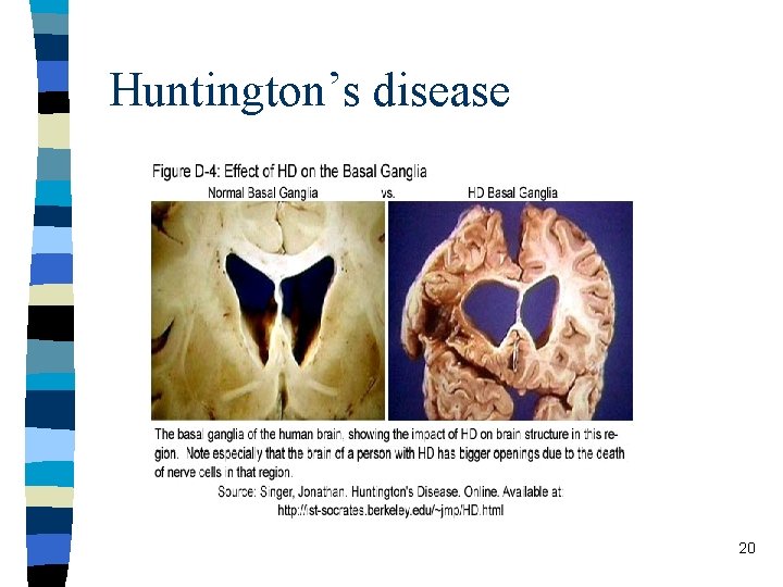 Huntington’s disease 20 