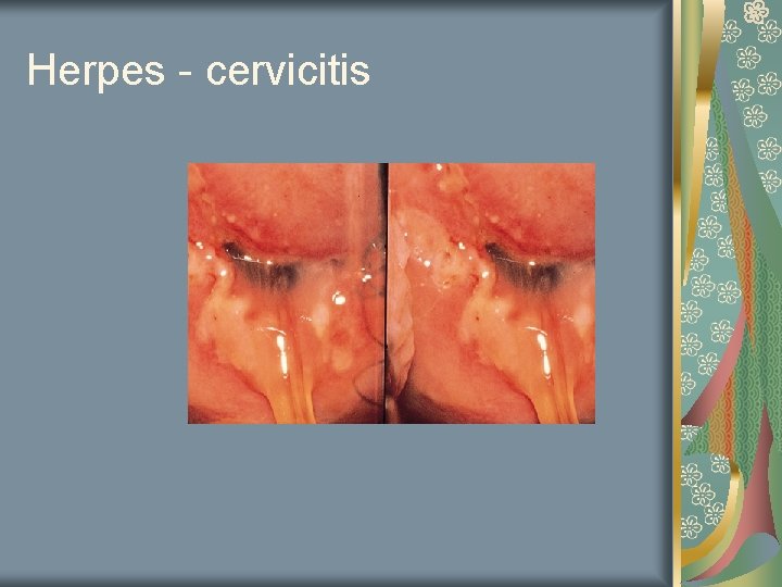 Herpes - cervicitis 