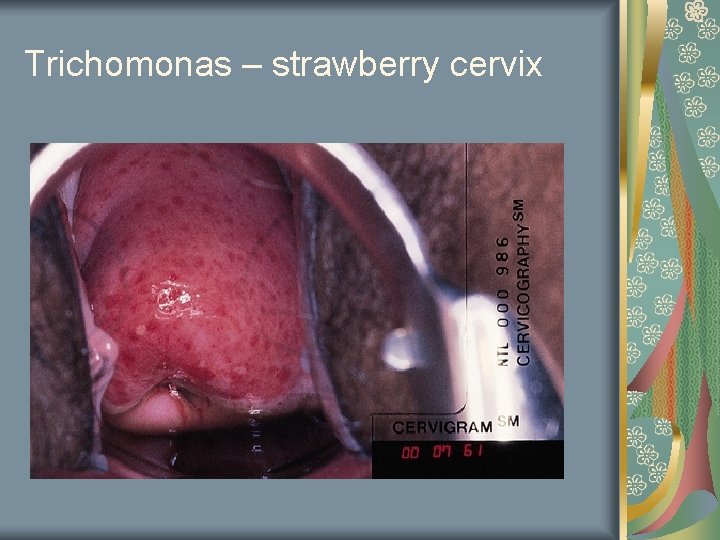 Trichomonas – strawberry cervix 