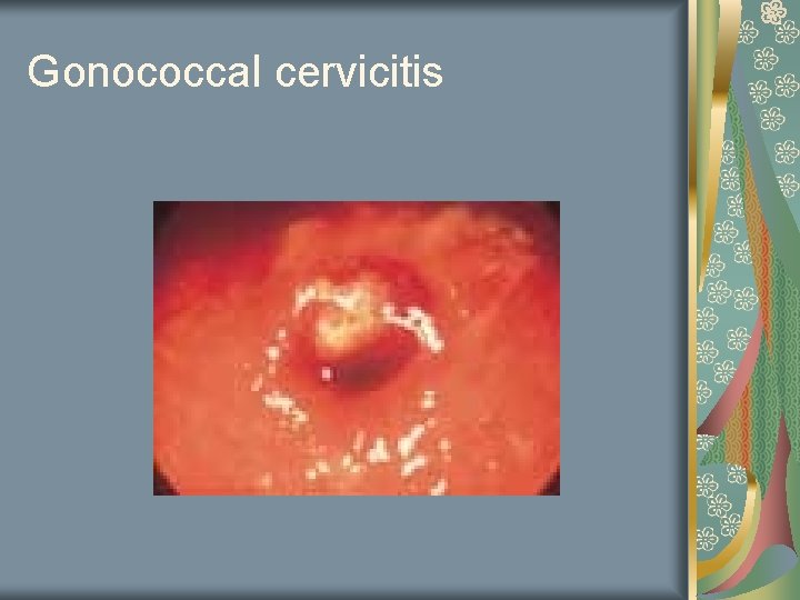 Gonococcal cervicitis 