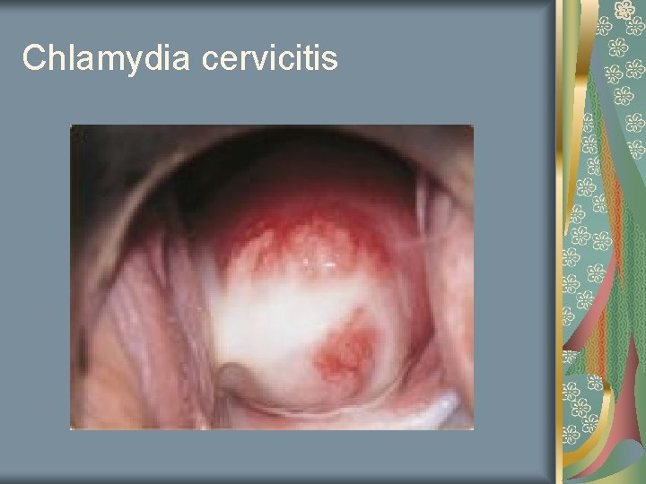 Chlamydia cervicitis 