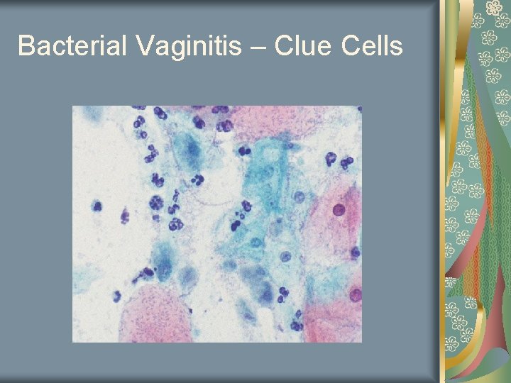 Bacterial Vaginitis – Clue Cells 