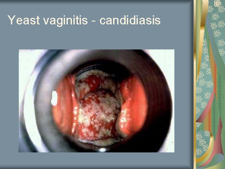 Yeast vaginitis - candidiasis 