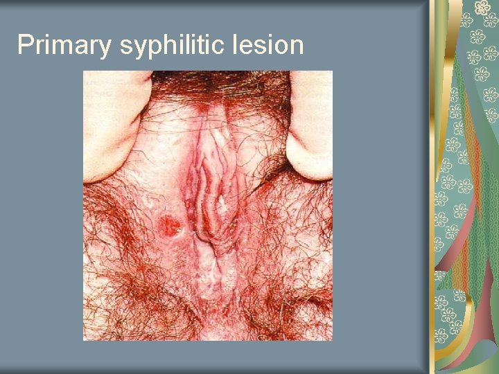 Primary syphilitic lesion 
