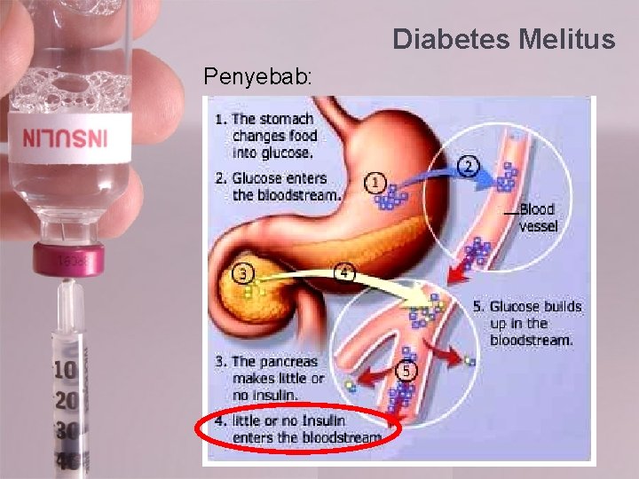 Diabetes Melitus Penyebab: 