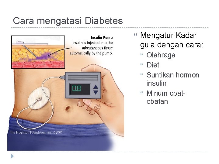 Cara mengatasi Diabetes Mengatur Kadar gula dengan cara: Olahraga Diet Suntikan hormon insulin Minum
