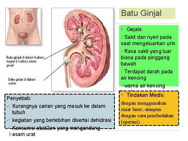 Batu Ginjal Gejala: üSakit dan nyeri pada saat mengeluarkan urin üRasa sakit yang luar